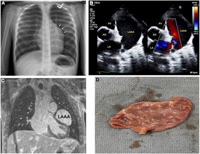 Left atrial appendage aneurysm in pediatrics: Case study and literature review